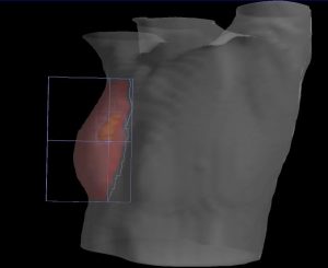 3D Darstellung des Zielvolumens und der Bestrahlungsfelder bei Mammakarzinom (rot Brustdrüse, orange Tumorregion)