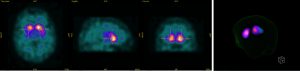 die Datenauswertung zeigt verschiedene Schnittebenen des DaTSCAN (3 Bilder links) und die 3D-Rekonstruktion (rechts)