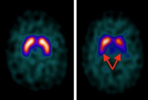 Normaler DaTSCAN links, rechts mit Dopaminrezeptormangel bei einem beginnenden M. Parkinson, Verlust an Rezeptoren mit Pfeilen gekennzeichnet