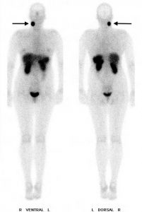 Nachweis eines sogenannten „Glomustumor“ rechts am Hals von vorne (links) und hinten (rechts)