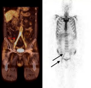 Aortenprotheseninfektion sichtbar in der Granulozytenszintigraphie (rechts) und PET-CT (links)