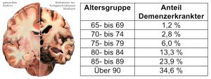 Die Abbildung zeigt links den Vergleich zwischen normaler Hirnanatomie und einer Demenz im fortgeschrittenen Stadium. Rechts: Tabelle der altersabhängigen Erkrankungshäufigkeit.