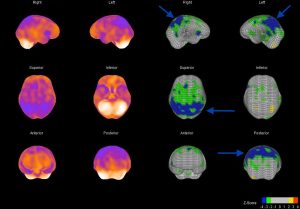 Oberflächendarstellung der Hirndurchblutung und sogenannte Z-Score-Darstellung bei einem Alzheimer Patient, Minderdurchblutungen mit Pfeil markiert (blaue Areale)