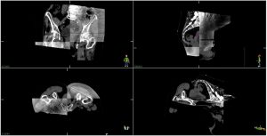 Täglicher Abgleich des Planungs-CT (dunkelgrau) mit dem ConeBeam-CT direkt vor Behandlung (hellgrau)