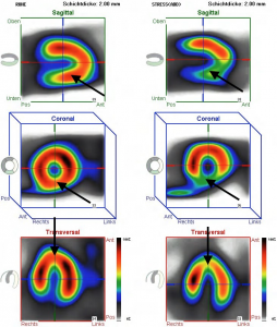 Myokardszintigraphie mit Durchblutungsstörungen, links Untersuchung in Ruhe, rechts unter Belastung. Die Pfeile markieren differente Bereiche