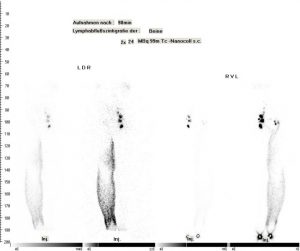 Lymphszintigraphie der Beine (normaler Lymphabfluss rechts, Lymphgefäßerkrankung links)