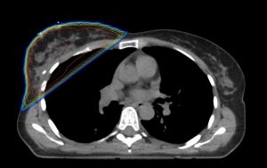 Dosisverteilung 3D konformale Radiotherapie der Brustdrüse