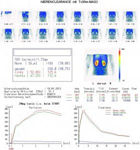 Nierenszintigraphie mit seitengetrennter Ausscheidungsmessung (Nierenclearence) (hier: Normalbefund)