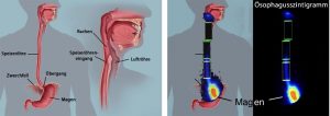 Anatomie der Speiseröhre (links) und Schluckakt in der Szintigraphie (rechts)