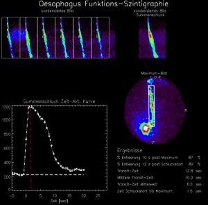 Oesophagus-Funktionsszintigraphie