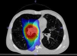 Dosisverteilung der VMAT bei Behandlung eines Lungentumors
