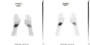 Verstärkte Anreicherung in den Handgelenken bei chronischer Polyarthritis