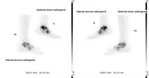 Rheumatoide Arthritis oberes Sprunggelenk