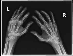 Schwere Polyarthritis der Hände mit ausgeprägter Gelenkdestruktion