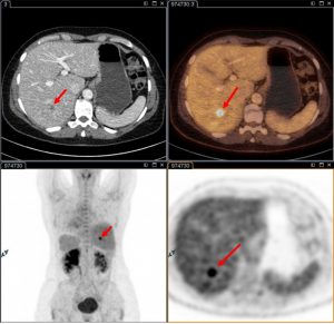 Patient mit Darmkrebs in der Vorgeschichte und einem unklaren Herdbefund in der Leber. Obere Reihe: Links: Kontrastmittel CT der Leber mit einem nicht näher zu klassifizierendem Herdbefund (mit Pfeil gekennzeichnet), <br />Rechts: die fusionierten PET/CT-Bilder mit Darstellung einer hochstoffwechselaktiven Lebermetastase (mit Pfeil gekennzeichnet) <br />Untere Reihe: PET-Bilder