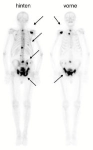 Multiple Knochenmetastasen z. T. mit Pfeilen markiert