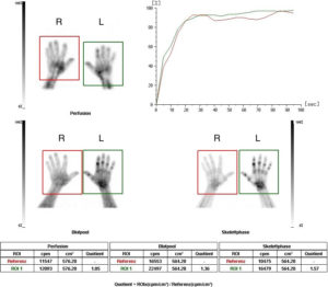 Drei-Phasenskelettszintigraphie bei M. Sudeck (CRPS) der linken Hand