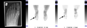 Mittelfußfraktur, im Röntgenbild (links) noch nicht, im Szintigramm (siehe Pfeil) sehr wohl zu erkennen